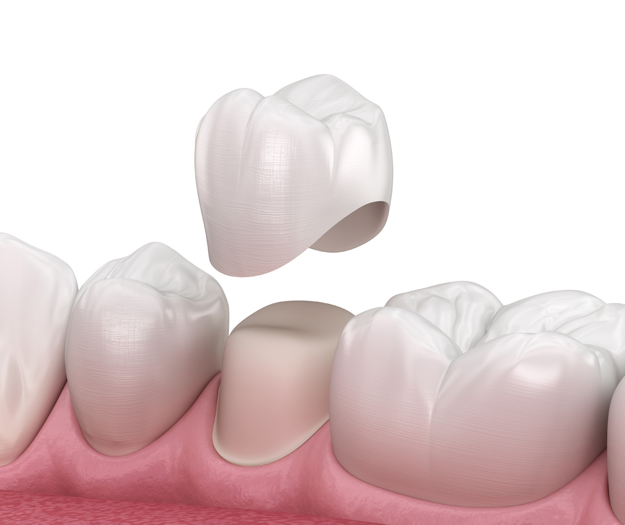 Dental crown placement illustration showing how a crown caps the whole tooth versus a veneer