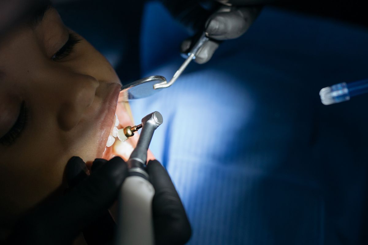 A dental sealant being applied to a child molar to prevent cavities