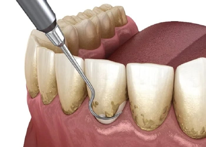 Dental hygienist performing a cleaning — when scaling and root planing is necessary