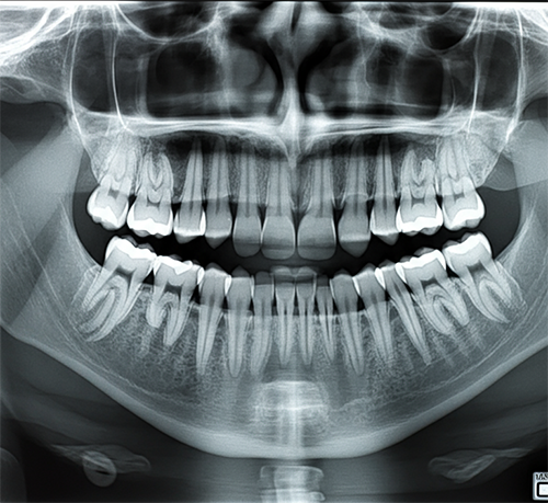 Panoramic dental X-ray under independent expert review — a dentist systematically reading teeth, bone levels, and periapical anatomy for a second opinion