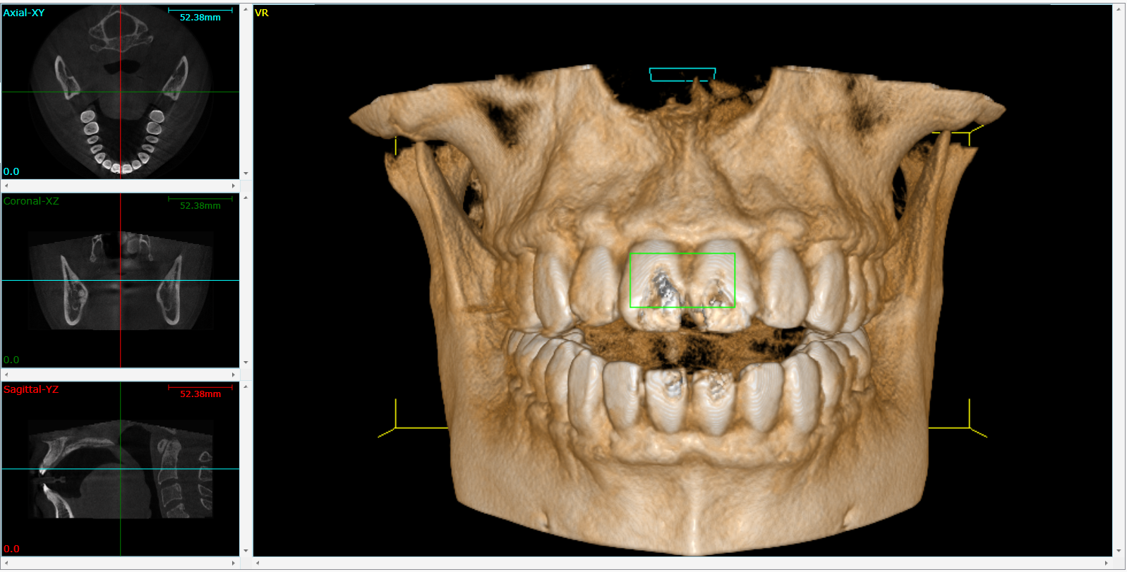 Dental CBCT scan illustrating implant planning imaging