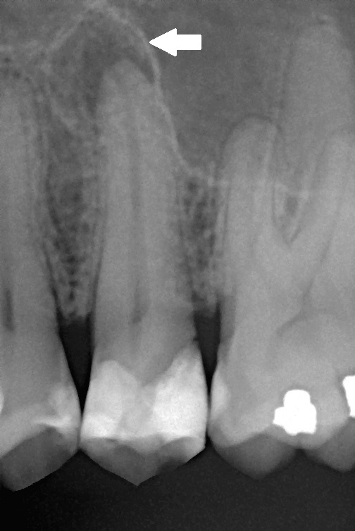 Chronic apical periodontitis illustrating treatment-decision variability between dentists