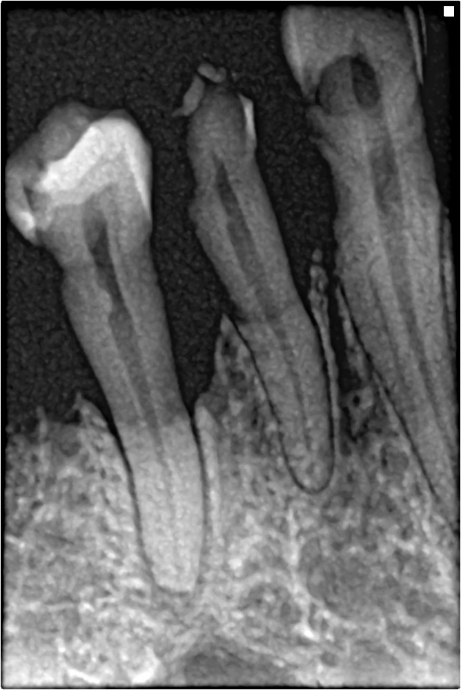 Periapical X-ray showing periodontal bone loss — the type of finding where two qualified dentists frequently reach different treatment conclusions, well-documented in published research
