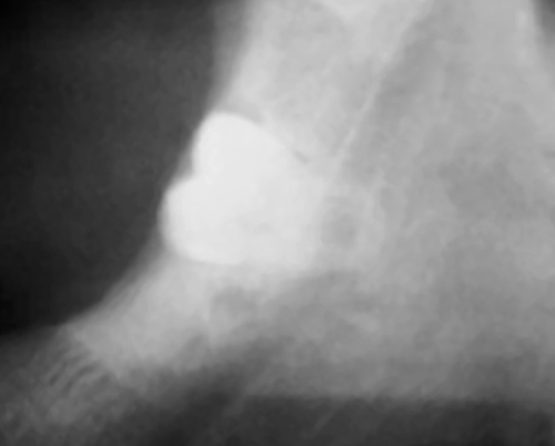 Panoramic dental X-ray showing an impacted wisdom tooth — the kind of high-stakes irreversible decision where an independent second opinion has the most value