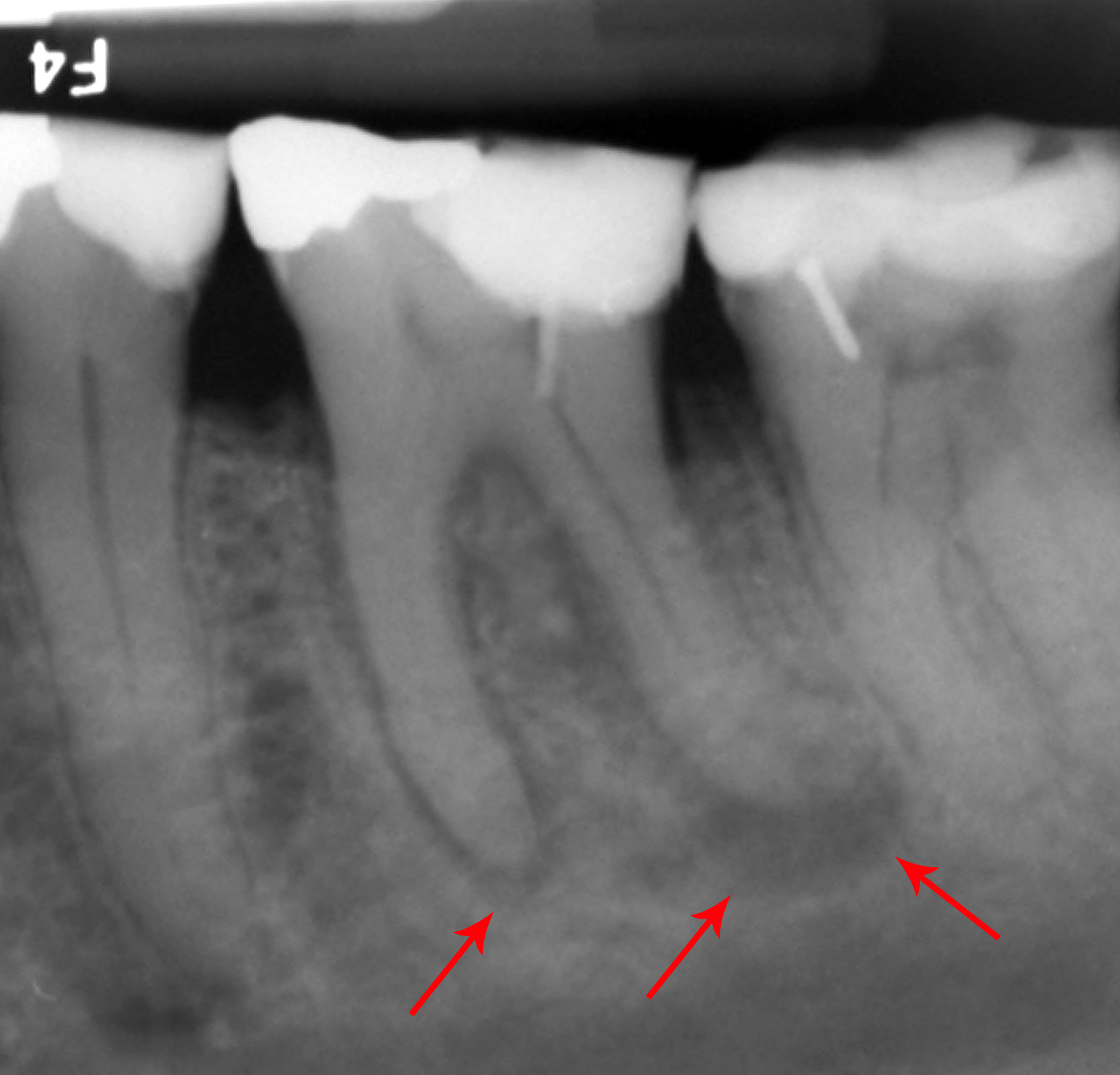 Periapical X-ray showing a tooth with periapical abscess — the kind of finding where the decision between saving the tooth with root canal and crown versus extraction and implant must be made on the clinical evidence