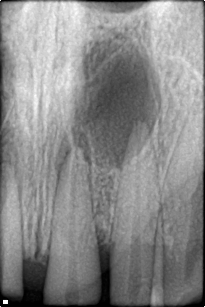 Dental X-ray showing a periapical lesion at the root tip, a sign a previous root canal may have failed