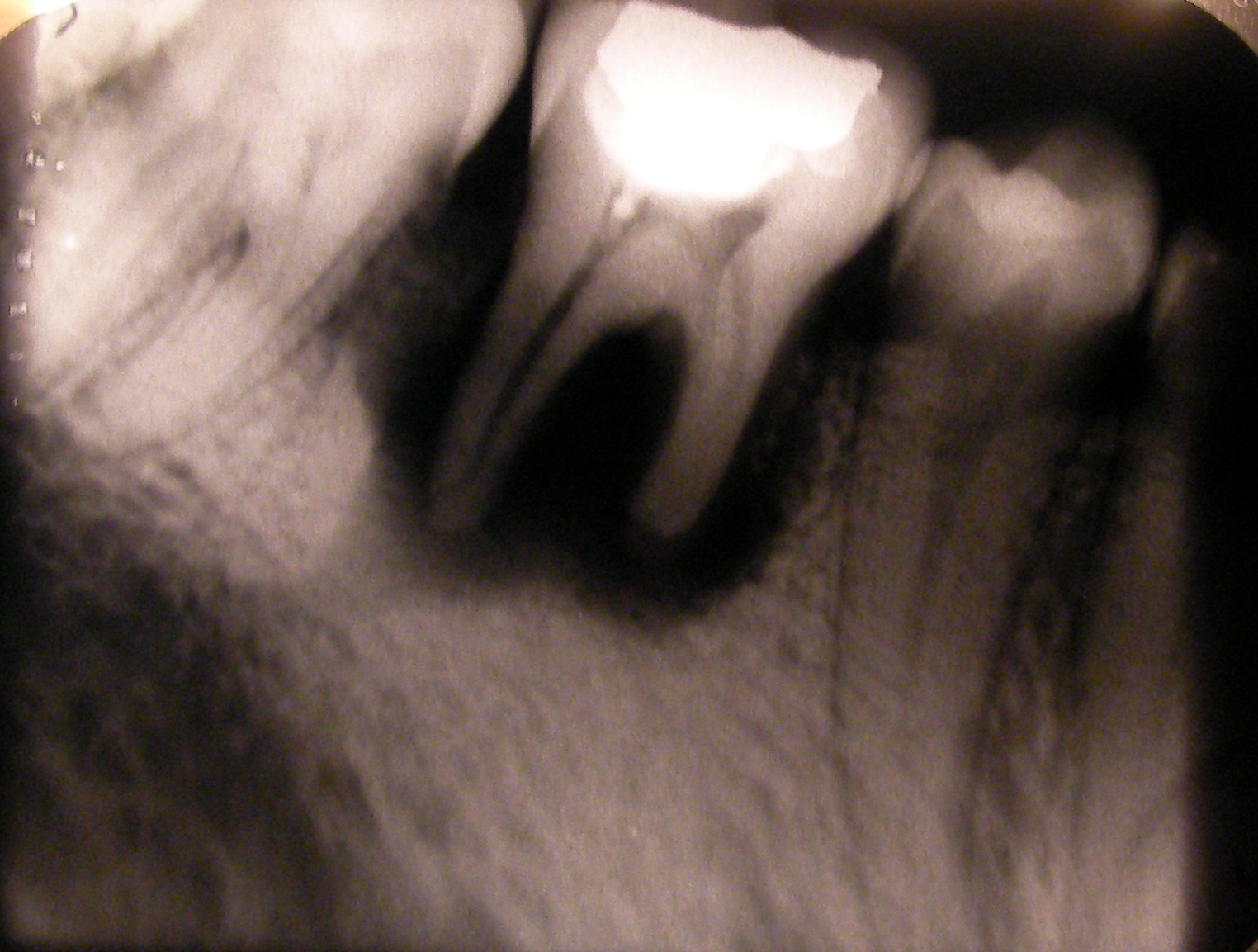 Dental X-ray showing root resorption and deep decay approaching the pulp — a sign that root canal treatment may be needed